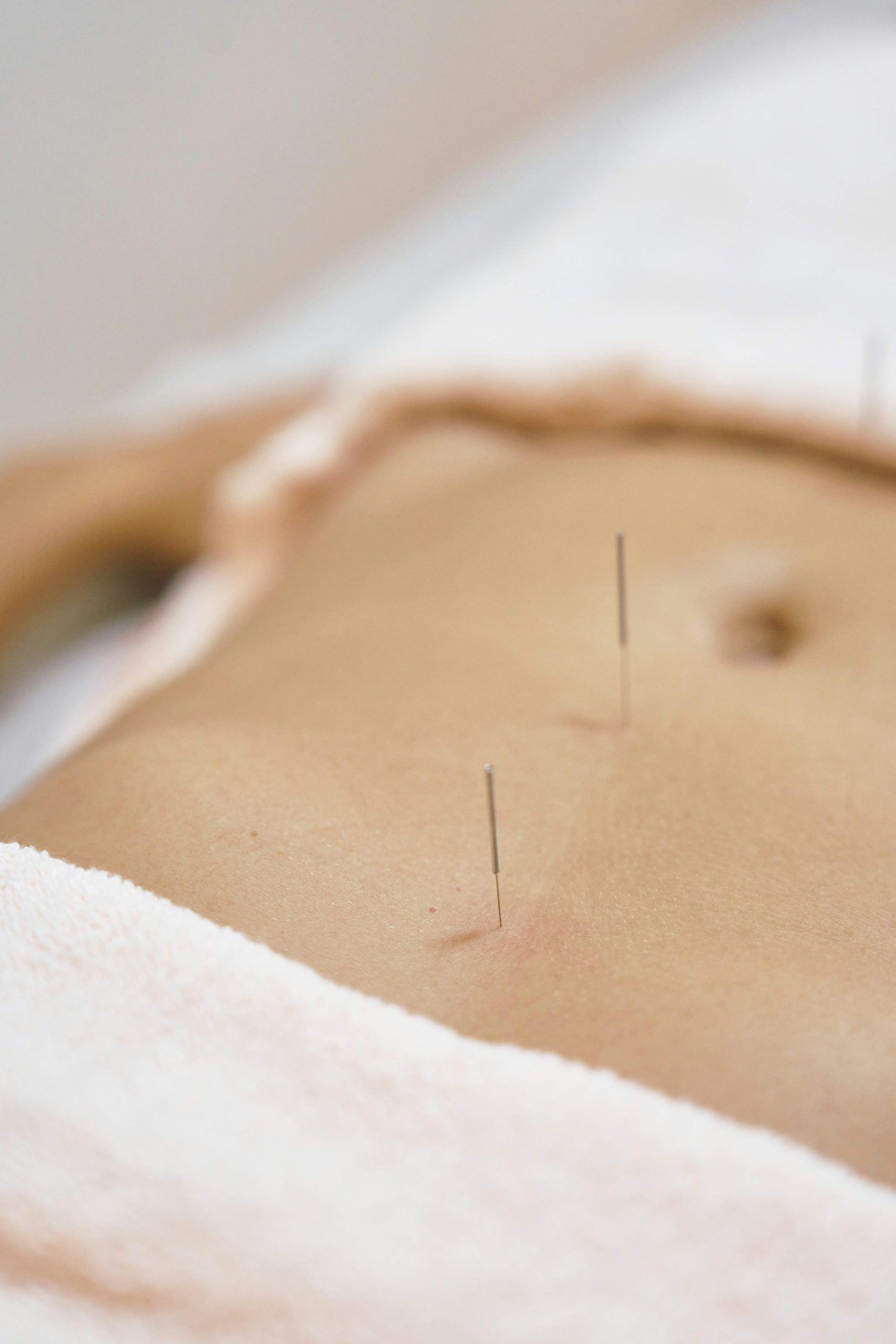 Acupuncture treatment